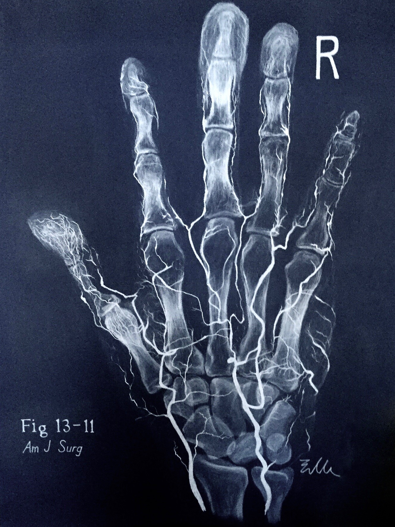 Dr. Elle Chapel's Radiograph of a Hand done in charcoal